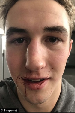One of the images of Ben Kebbell from a Snapchat that he shared moments after being punched in the face his ex-girlfriend, Kathryn A. Mohoney.