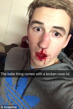 The ex-boyfriend of Katie Anna, Ben Kebbell, who has shared his broken nose on social media.