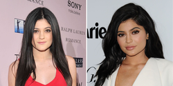 Kylie Jenner before and after having work done by Dr. Ourian