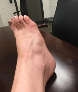 Photo of Andrea Martinez's broken foot after the alleged assault