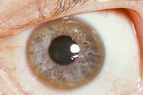 A Kayser–Fleischer ring in a patient with Wilson's disease