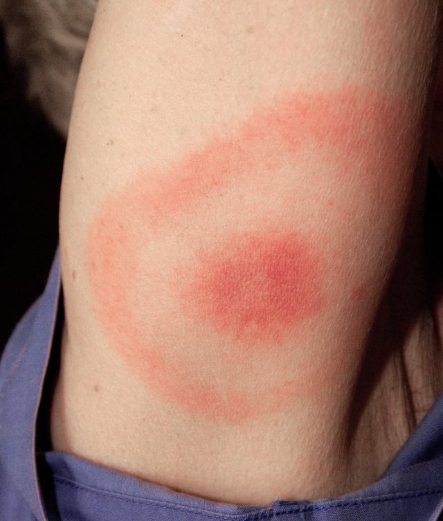 An expanding rash is an initial sign of about 80% of Lyme infections. The rash may look like a "bull's eye," as pictured, in about 80% of cases in Europe and 20% of cases in the US.