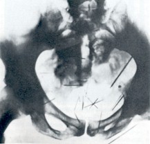 X-ray of Fish's pelvis and perineum, introduced as evidence at his trial, demonstrating more than two dozen self-embedded needles