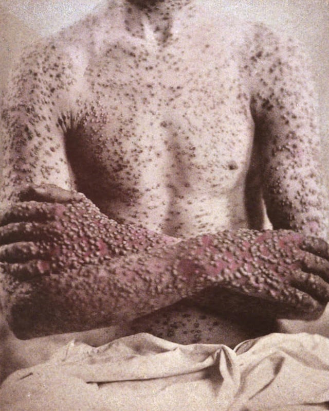 A case of smallpox, 1886