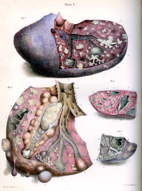 Robert Carswell's illustration of tubercle