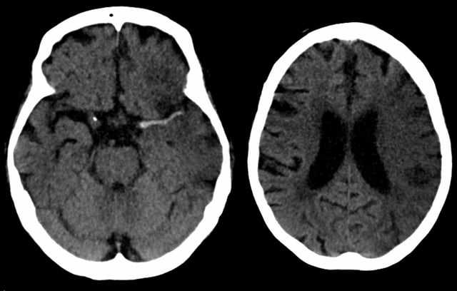 Dens media sign in a patient with middle cerebral artery infarction shown on the left.