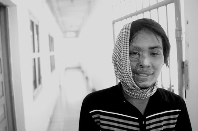 Acid attack victim in Cambodia