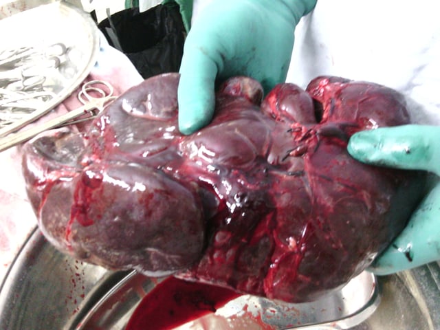 Surgically removed spleen of a Thalassemic child. It is about 15 times larger than normal.