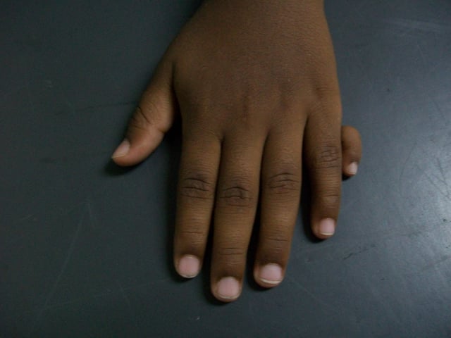 Type 1 ulnar polydactyly - an extra digit is attached by skin and nerves.