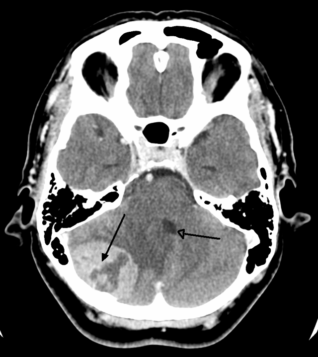 A posterior fossa tumor leading to mass effect and midline shift