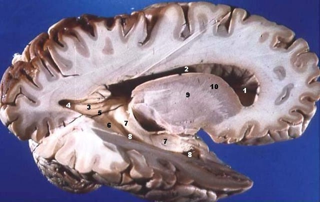 A dissected human brain, showing grey matter and white matter