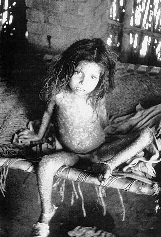 A child showing rash due to ordinary-type smallpox (variola major)