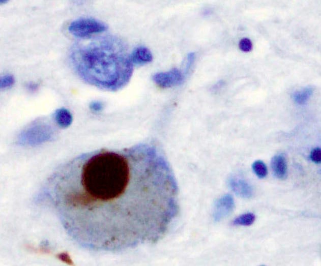 A Lewy body (stained brown) in a brain cell of the substantia nigra in Parkinson's disease. The brown colour is positive immunohistochemistry staining for alpha-synuclein.