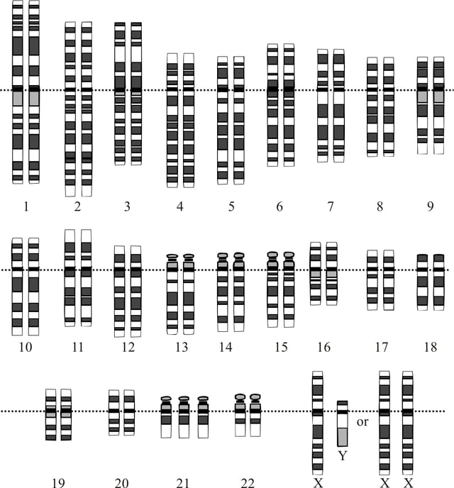 Chromosomes in Down syndrome, the most common human condition due to aneuploidy. There are three chromosomes 21 (in the last row).