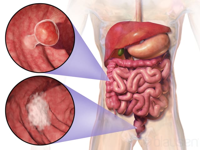 Location and appearance of two example colorectal tumors