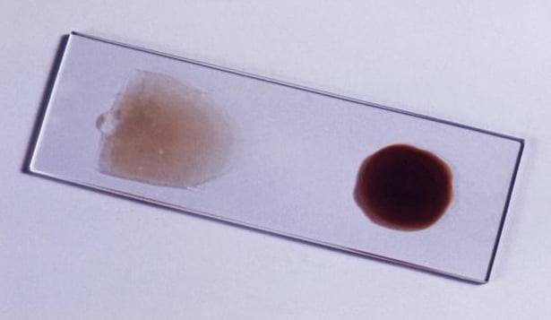 The blood film is the gold standard for malaria diagnosis.