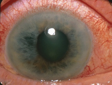 Photo showing conjunctival vessels dilated at the corneal edge (ciliary flush, circumcorneal flush) and hazy cornea characteristic of acute angle closure glaucoma