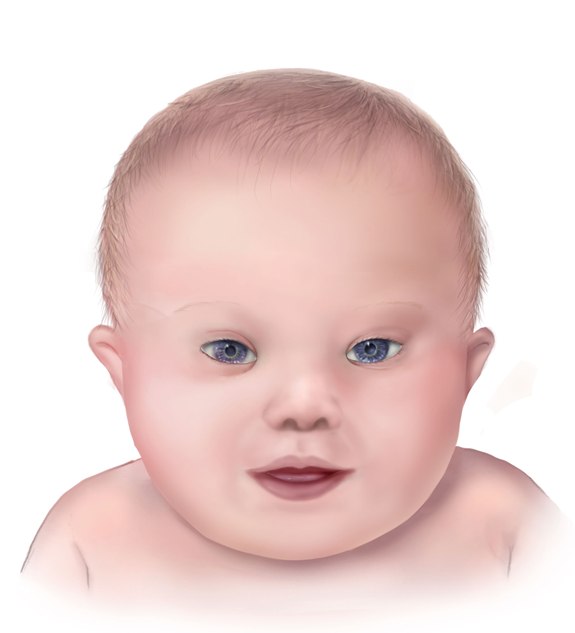 A drawing of the facial features of a baby with Down syndrome