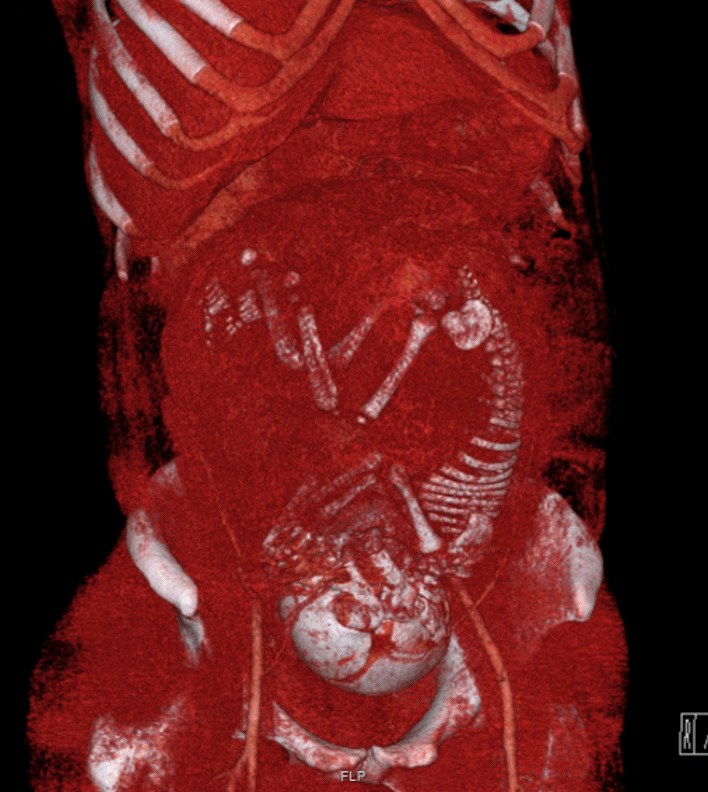 CT scanning (volume rendered in this case) confers a radiation dose to the developing fetus.