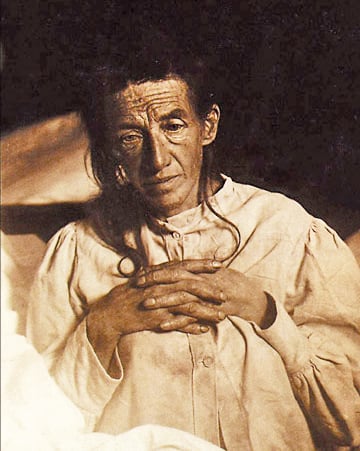 Alois Alzheimer's patient Auguste Deter in 1902. Hers was the first described case of what became known as Alzheimer's disease.