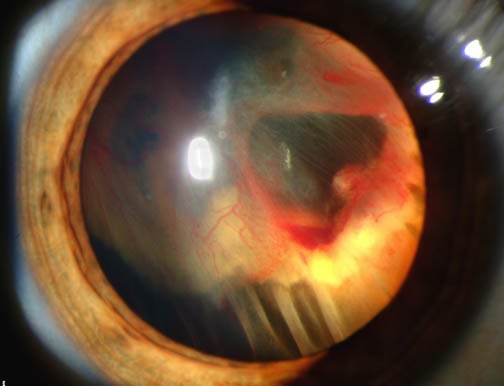 Slit lamp photograph showing retinal detachment in Von Hippel-Lindau disease.