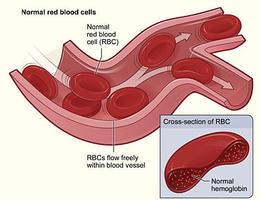 Figure shows normal red blood cells flowing freely in a blood vessel. The inset image shows a cross-section of a normal red blood cell with normal hemoglobin.