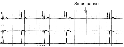 Normal sinus rhythm, with solid black arrows pointing to normal P waves representative of normal sinus node function, followed by a pause in sinus node activity (resulting in a transient loss of heart beats). Note that the P wave that disrupts the pause (indicated by the dashed arrow) does not look like the previous (normal) P waves — this last P wave is arising from a different part of the atrium, representing an escape rhythm.