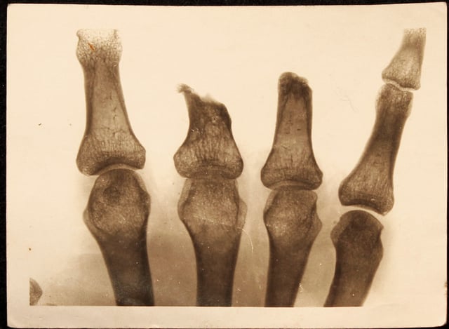 Three fingers from a soldier's right hand were traumatically amputated during World War I.