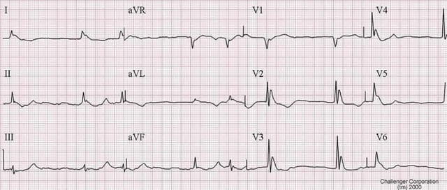 Atrial fibrillation and Osborn J waves in a person with hypothermia.  Note what could be mistaken for ST elevation.