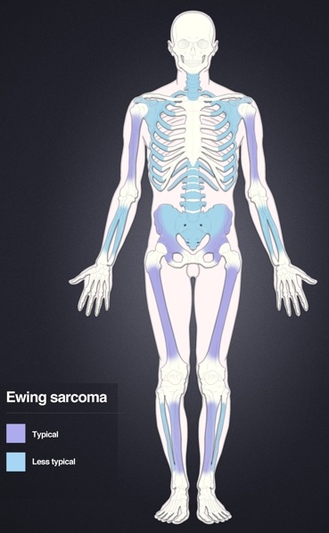 Distribution of Ewing's sarcoma: Most frequent locations are the large long bones and the pelvis.