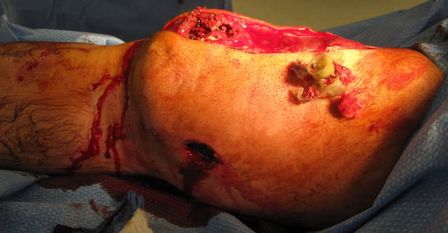 Acute penetrating trauma from a close-range shotgun blast injury to knee. Birdshot pellets are visible in the wound, within the shattered patella. The powder wad from the shotgun shell has been extracted from the wound, and is visible at the upper right of the image.
