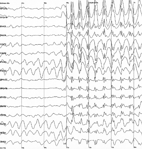 Brain electrical activity recorded from a human patient during an epileptic seizure