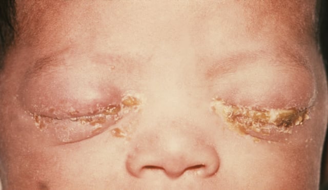 An infant with gonorrhea of the eyes