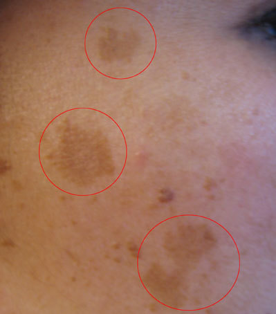 Melasma pigment changes to the face due to pregnancy