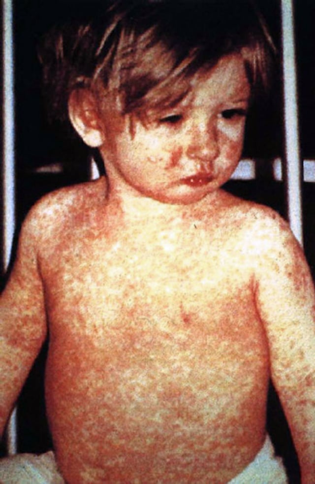A child with measles, a vaccine-preventable disease