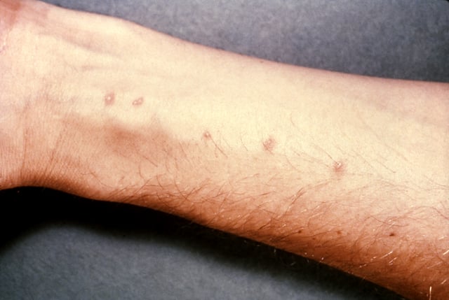 Skin vesicles created by the penetration of Schistosoma. (Source: CDC)