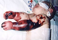 Charlotte Cleverley-Bisman developed severe meningococcal meningitis as a young child; in her case, the petechial rash progressed to gangrene and required amputation of all limbs. She survived the disease and became a poster child for a meningitis vaccination campaign in New Zealand.