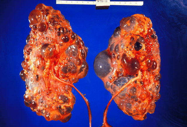 This tissue cross-section demonstrates the gross pathology of polycystic kidneys.