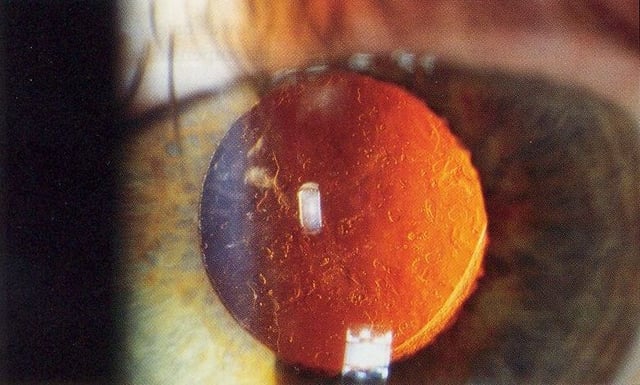 Slit lamp photo of posterior capsular opacification visible a few months after implantation of intraocular lens in eye, seen on retroillumination