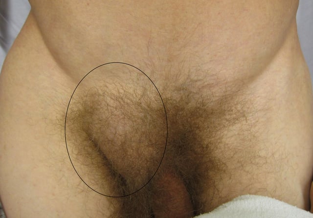 Frontal view of an inguinal hernia (right).