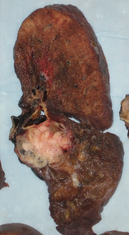 Pneumonectomy specimen containing a squamous-cell carcinoma, seen as a white area near the bronchi