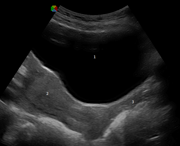 An ultrasound showing the urinary bladder (1), uterus (2), and vagina (3)