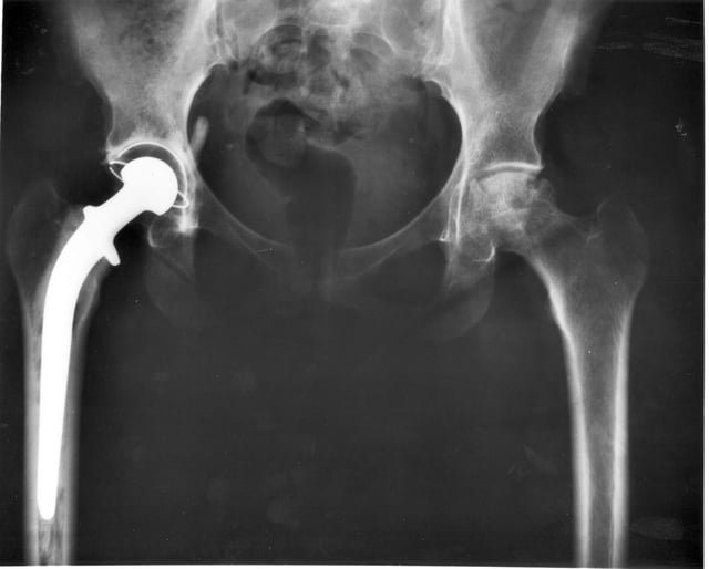 X-ray of a hip replacement.