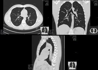 High-resolution CT scans of a normal thorax, taken in the axial, coronal and sagittal planes, respectively.