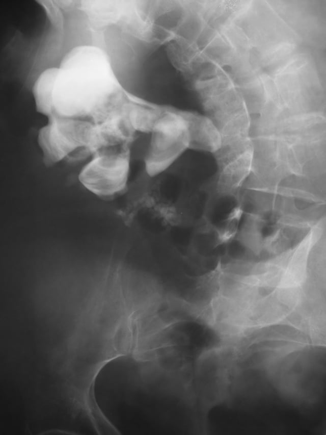 Radiograph showing a large staghorn calculus involving the major calyces and renal pelvis in a person with severe scoliosis.