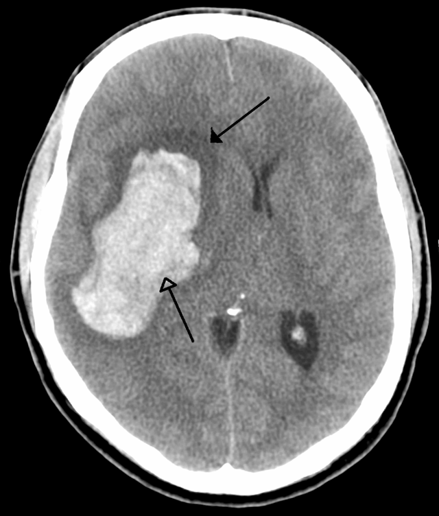CT scan of an intraparenchymal bleed (bottom arrow) with surrounding edema (top arrow)