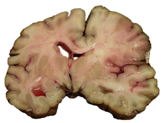 A slice of brain from the autopsy of a person who had an acute middle cerebral artery (MCA) stroke