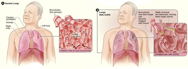 On the left is a diagram of the lungs and airways with an inset showing a detailed cross-section of normal bronchioles and alveoli. On the right are lungs damaged by COPD with an inset showing a cross-section of damaged bronchioles and alveoli.