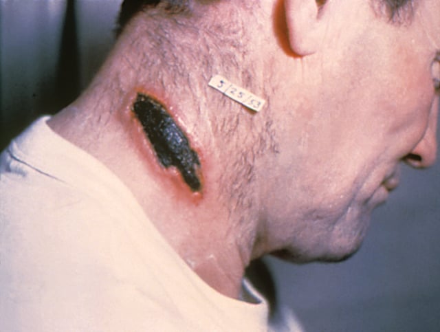 Skin anthrax lesion on the neck