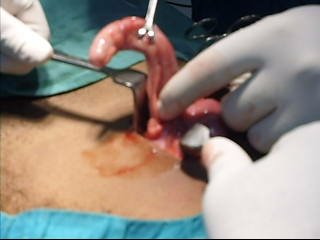 Inflamed appendix removal by open surgery